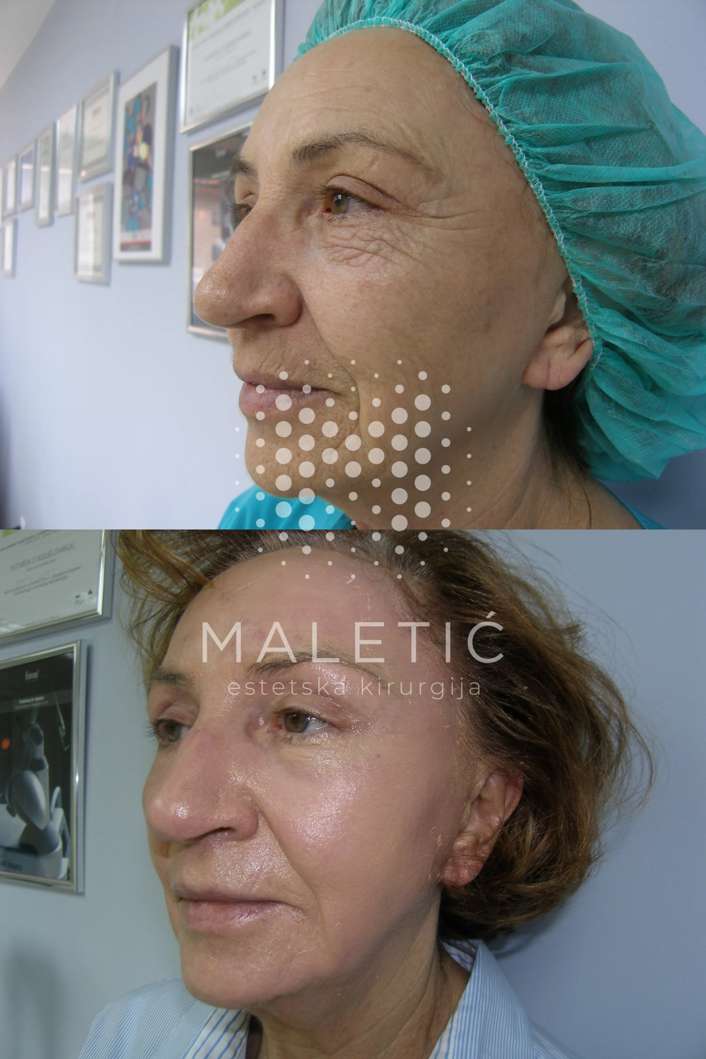 Lice prije i nakon Exoderm kemijskog pilinga u Poliklinici Maletić