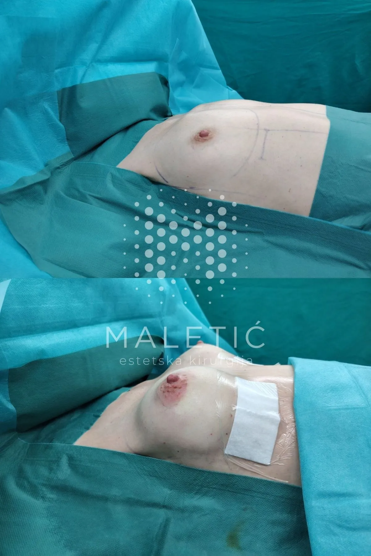 Prije i poslije povećanja grudi u Poliklinici Maletić — pacijentica 4