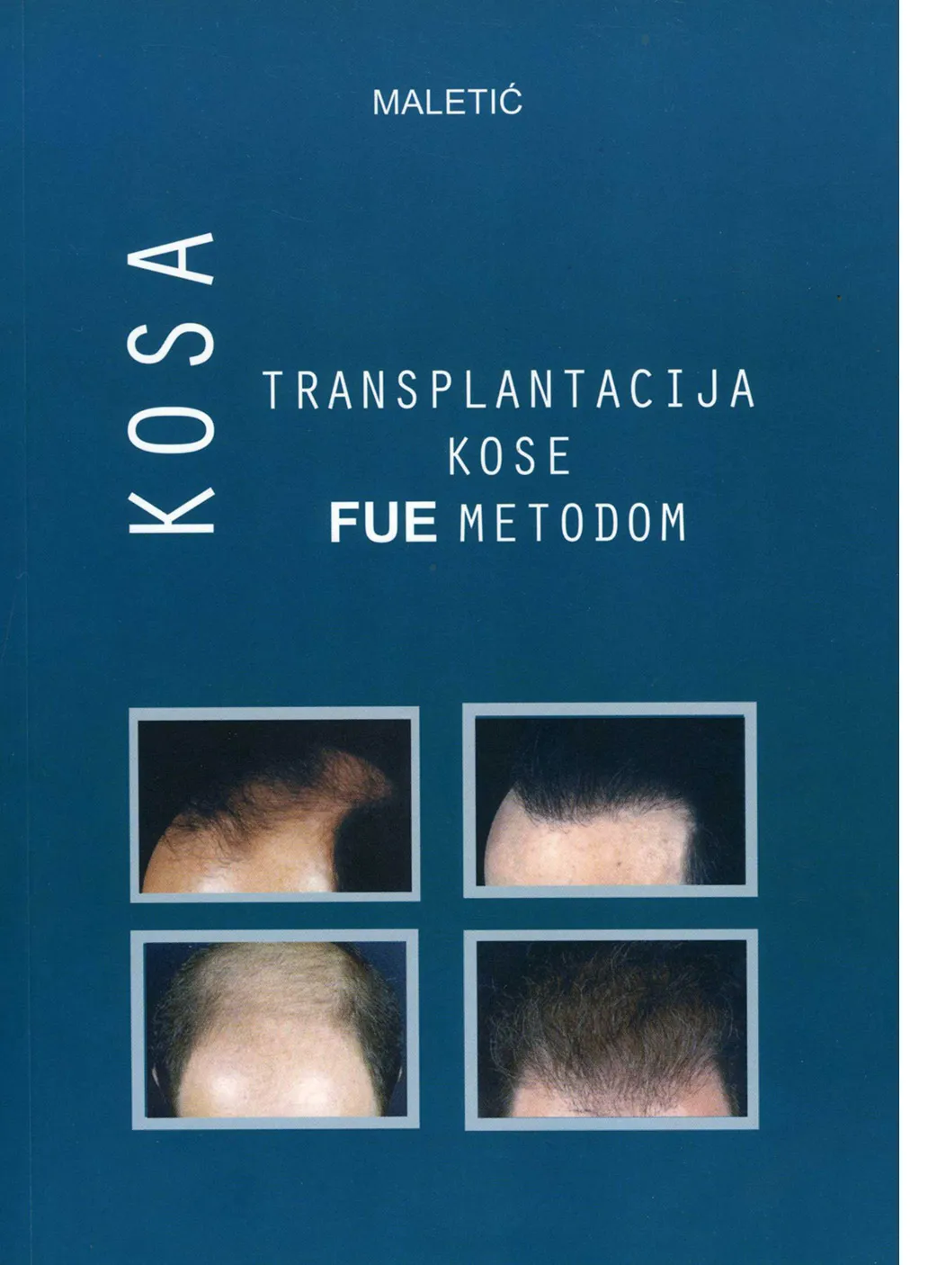 Naslovnica knjige Transplantacija kose FUE metodom, Poliklinika Maletić